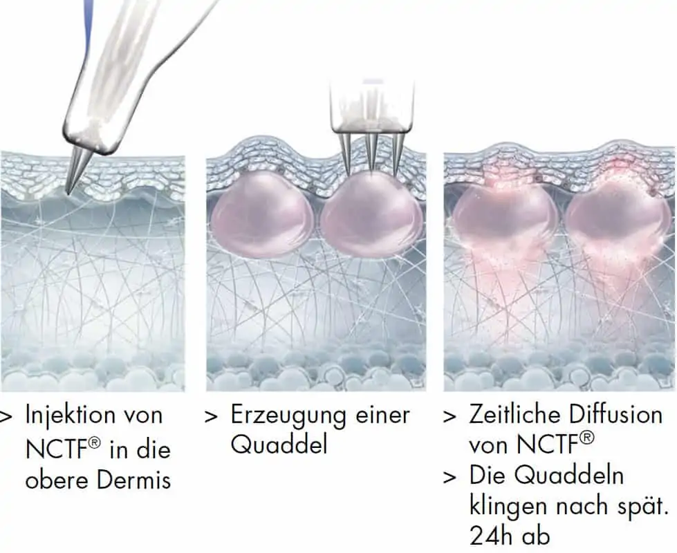 Nanosoft Injektion bei Dr. Stengel am Starnberger See