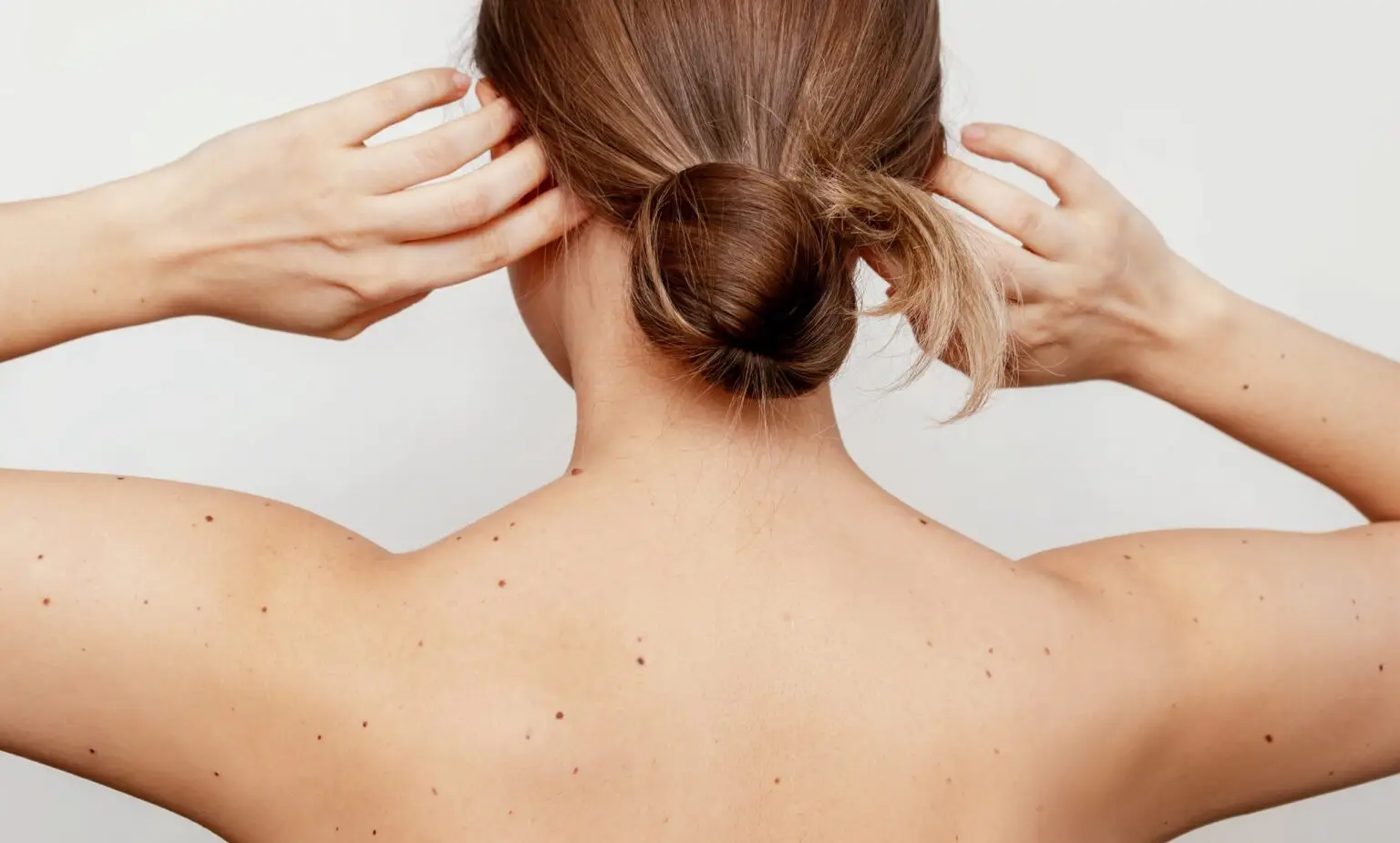 Muttermalen-ATBM Dermatologische Hautanalyse bei einer Patientin mit vielen Muttermalen zur frühzeitigen Erkennung von Hautveränderungen und Hautkrebsrisiken